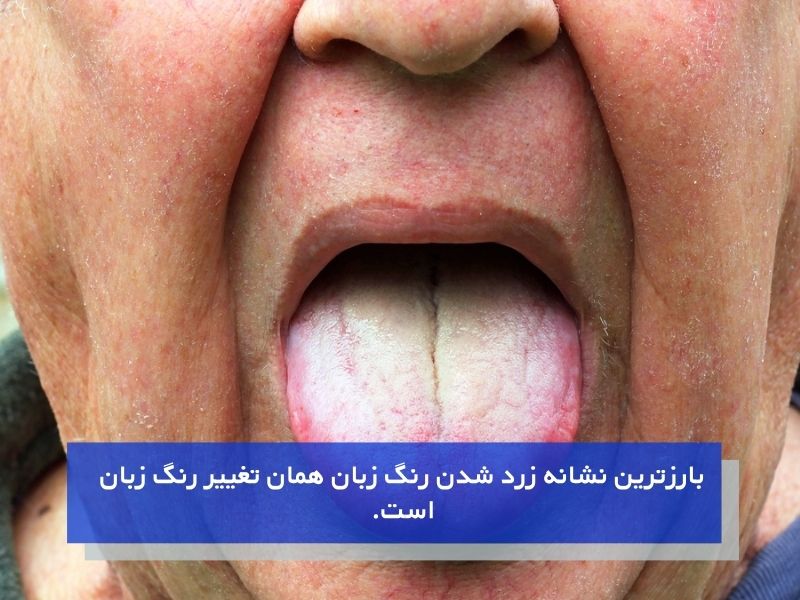 علائم و نشانههای زرد شدن زبان