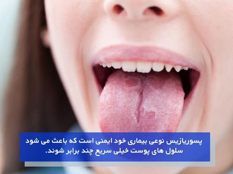 پسوریازیس دهان و ارتباط آن با زرد شدن زبان