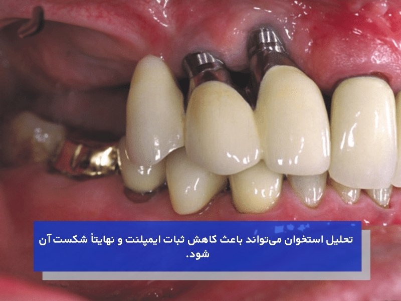 تاثیرات ایمپلنت بر روی استخوان فک