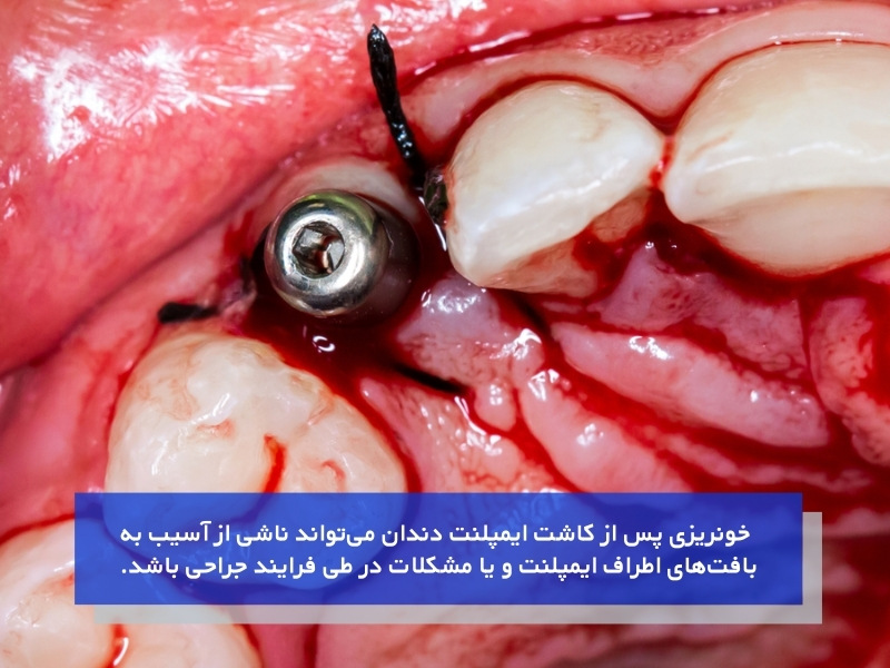 عوارض خونریزی پس از کاشت ایمپلنت