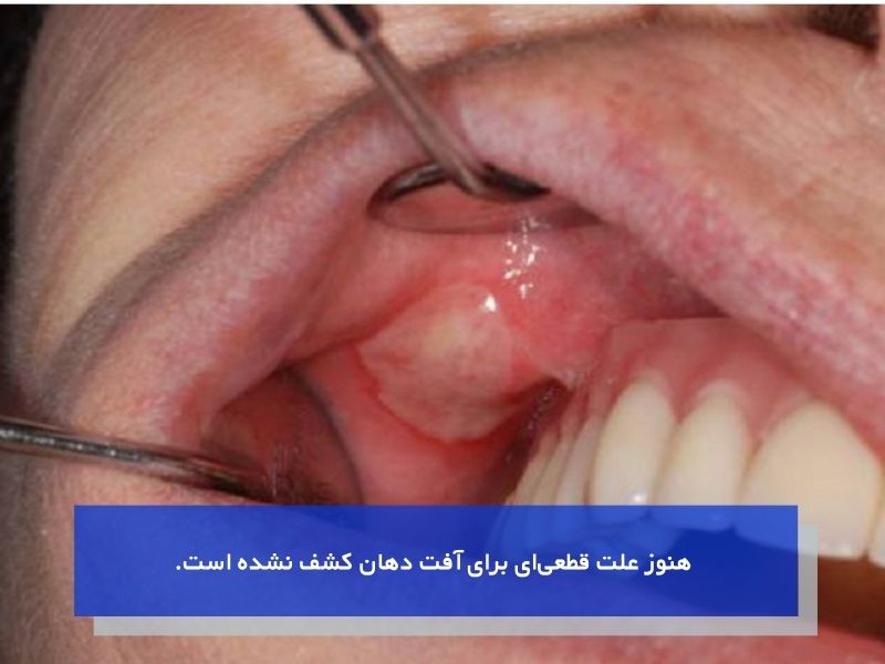 آفت دهان چگونه به وجود می‌آید