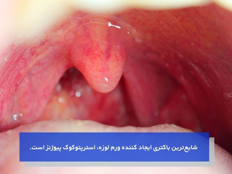 علت التهاب لوزه