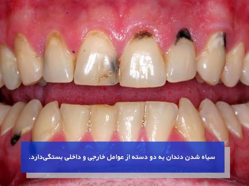 علت سیاه شدن دندان