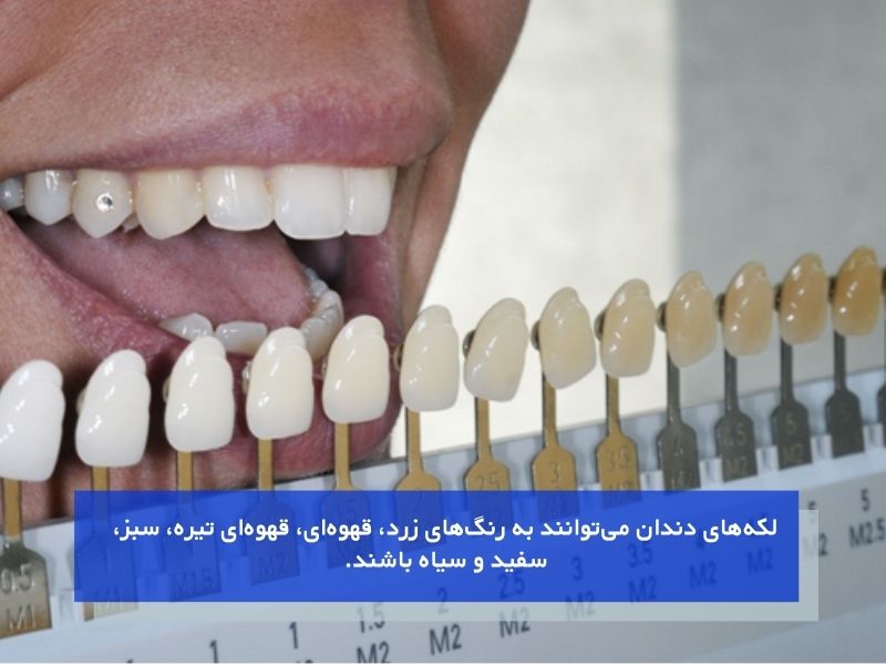 انواع رنگ لکههای دندانی