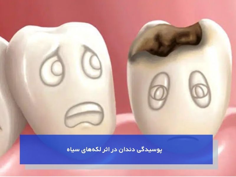 پوسیدگی دندان در اثر لکههای سیاه