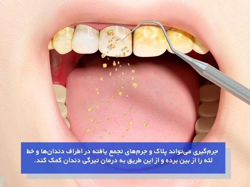 جرمگیری دندان و رفع لکههای سیاه