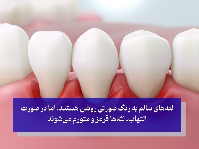 علائم التهاب لثه