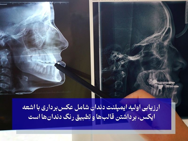ارزیابی اولیه از مراحل ابتدایی ایمپلنت دندان