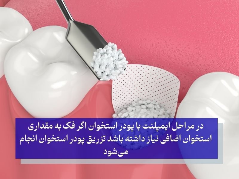 مراحل ایمپلنت با پودر استخوان