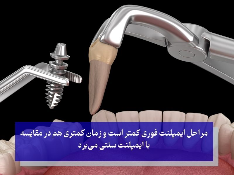 فرق مراحل ایمپلنت فوری با ایمپلنت معمولی
