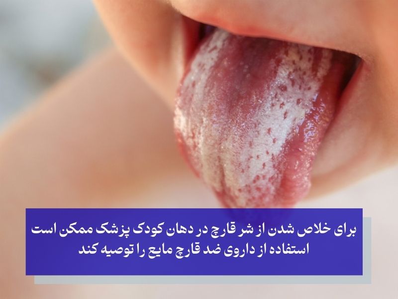 درمان برفک برفک در دهان نوزادان و کودکان