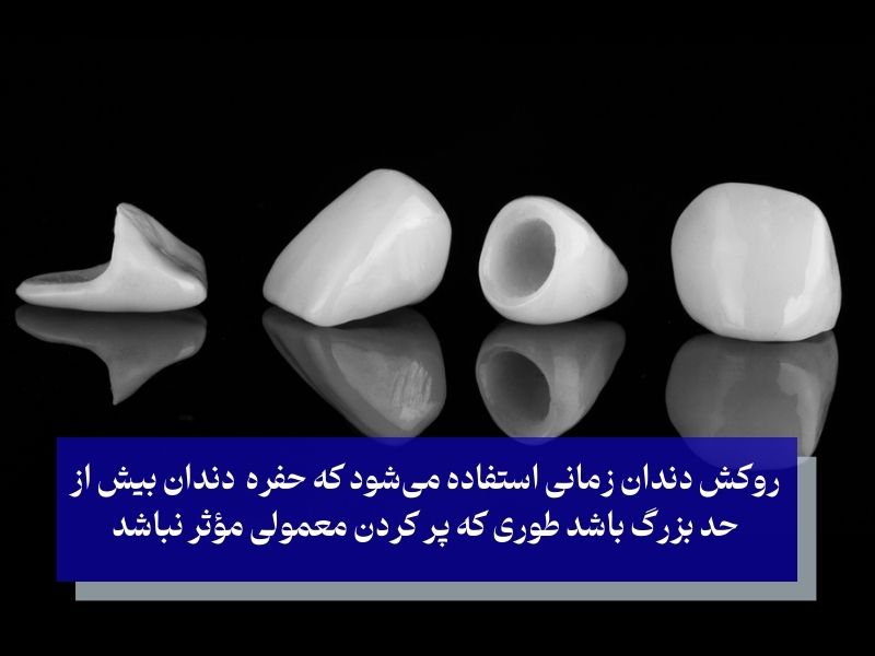 روکش‌های دندان رایج ترین روش ترمیم کردن دندان