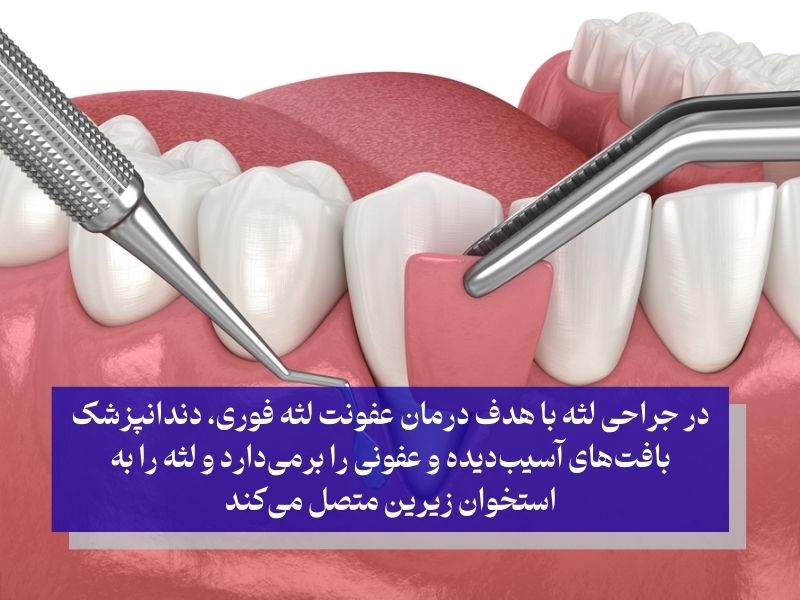 جراحی لثه برای درمان التهاب لثه پیشرفته