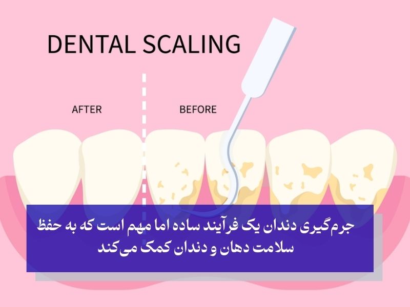 جرم گیری دندان چیست و چگونه انجام می‌شود
