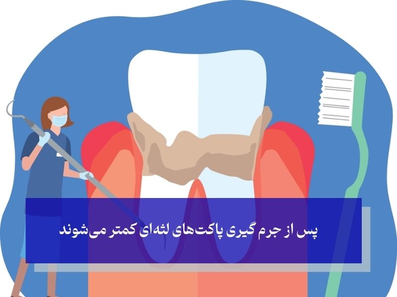 جرم گیری دندان چه تاثیری روی لثه‌ها دارد