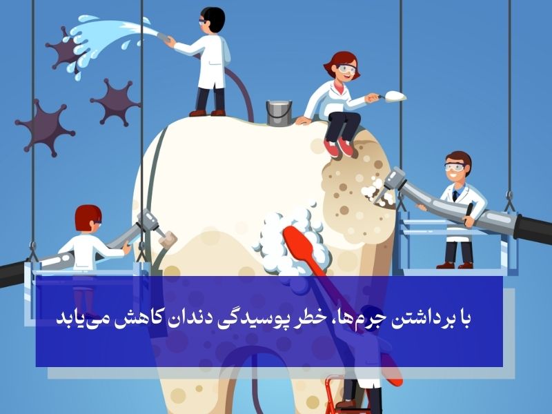 مزایای جرم گیری دندان