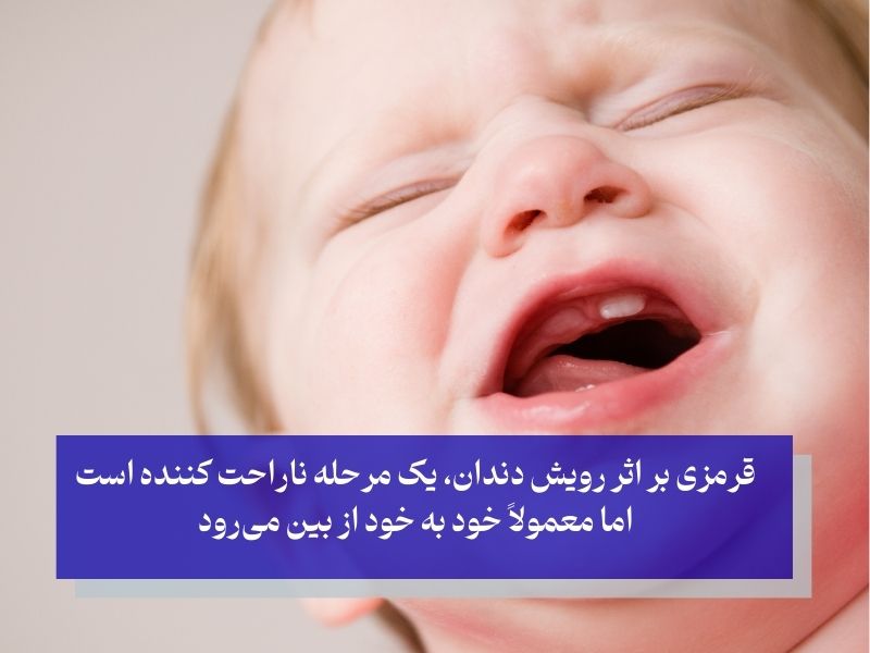 قرمزی یا کیست روی لثه رایج‌ترین علامت دندان در آوردن