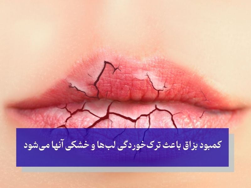 نشانه‌های خشکی دهان