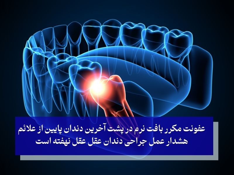 علائم هشدار برای نیاز به جراحی دندان عقل