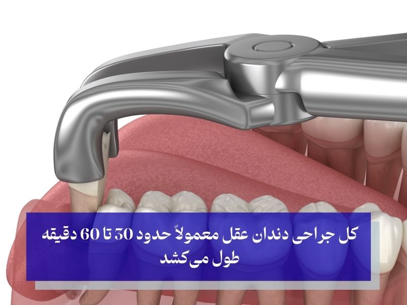 جراحی دندان عقل چقدر طول میکشد