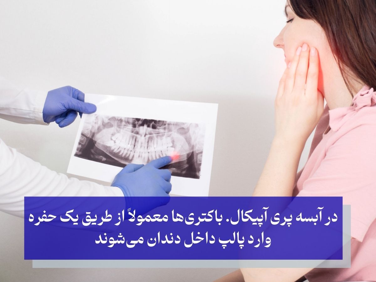 آبسه دندان عقل