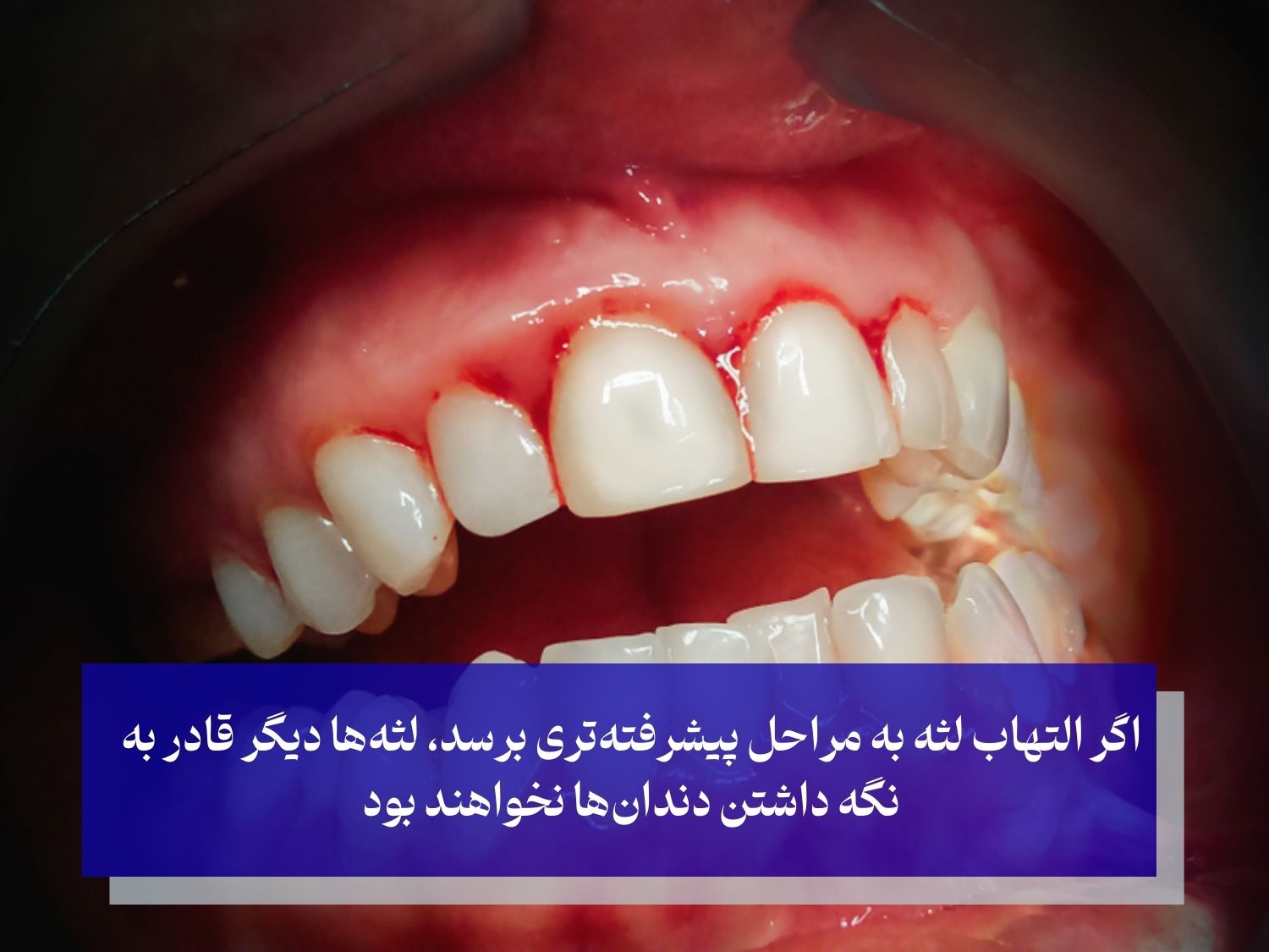 چرا نباید التهاب لثه را نادیده بگیریم