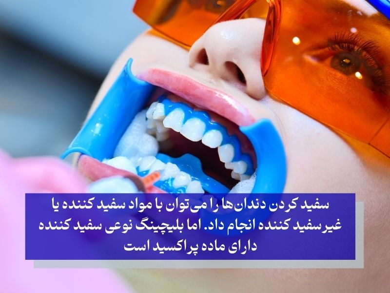 تفاوت بلیچینگ و سفید کردن دندان