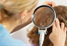 درمان فوری شپش در یک شب