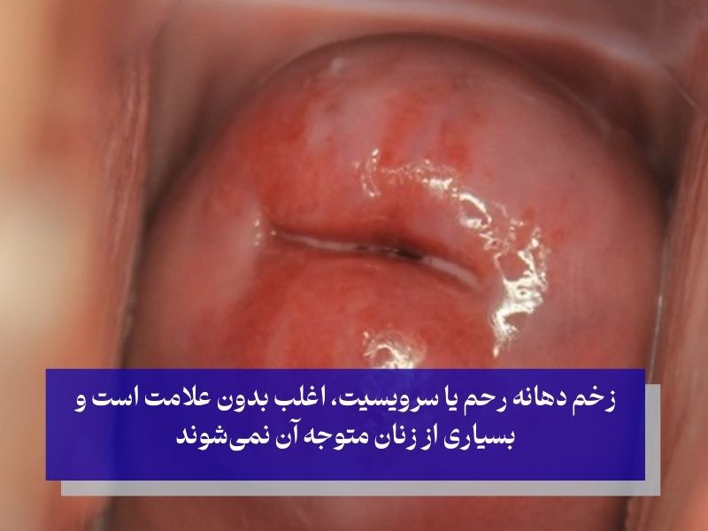 عکس زخم دهانه رحم