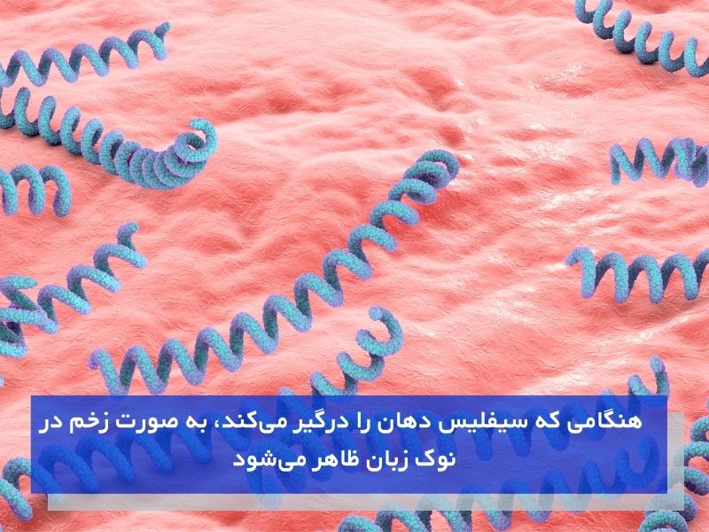 سیفلیس و ایجاد زخم و سفیدی بر روی زبان