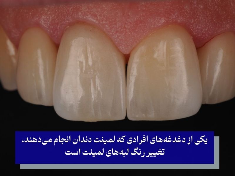 تغییر رنگ لبههای لمینت از عوارض لمینت دندان