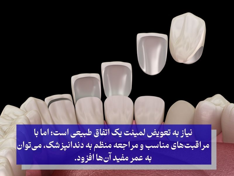 نیاز به تعویض از عوارض لمینت دندان