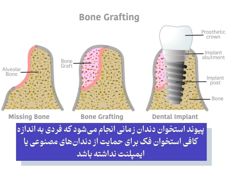چه کسانی به پیوند استخوان دندان نیاز دارند