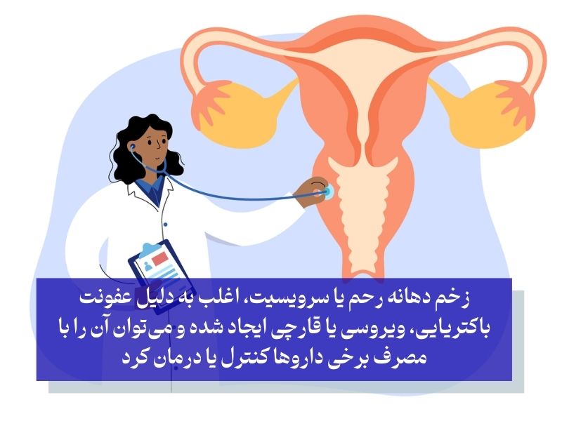 درمان دارویی زخم دهانه رحم