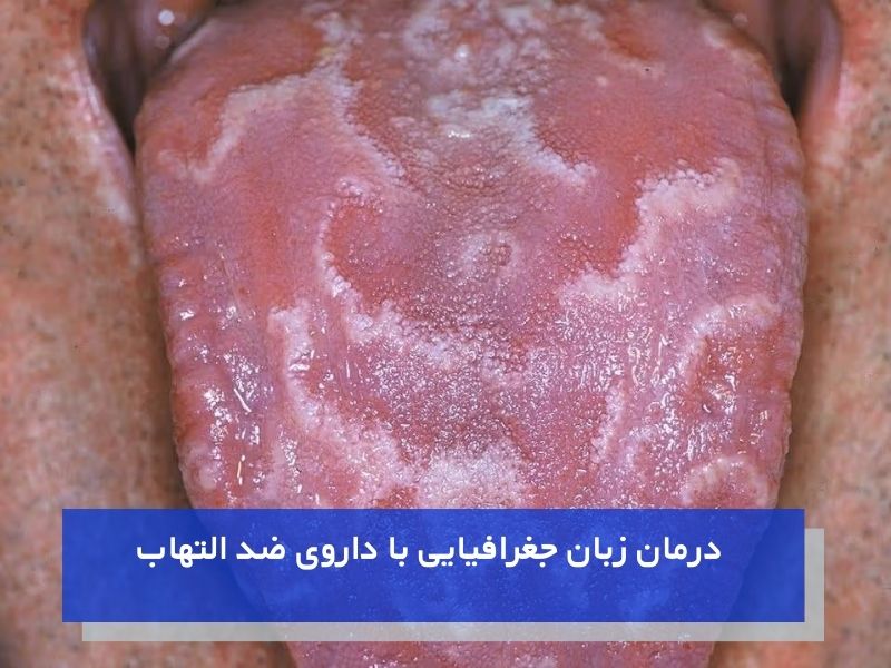 درمان زبان جغرافیایی با داروی ضد التهاب
