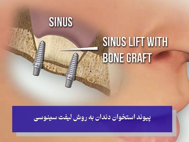 پیوند استخوان دندان به روش لیفت سینوسی