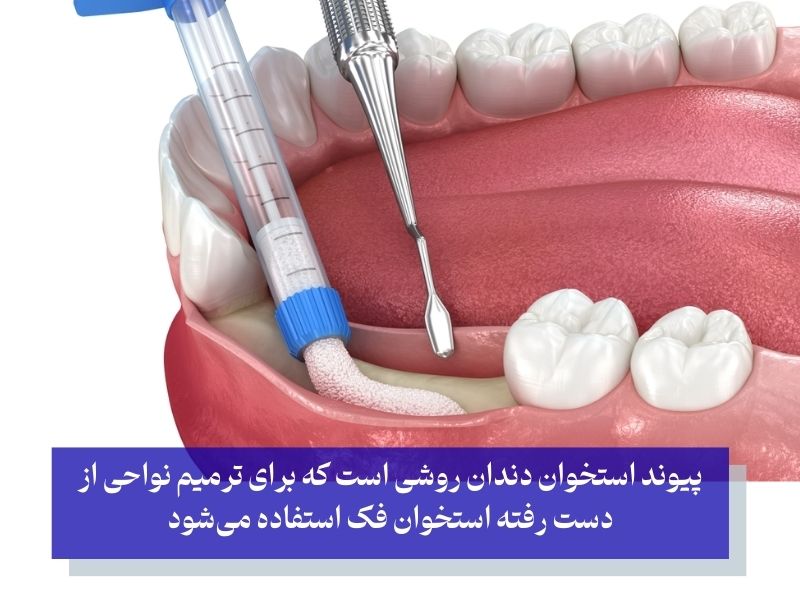 مزایا و معایب پیوند استخوان دندان
