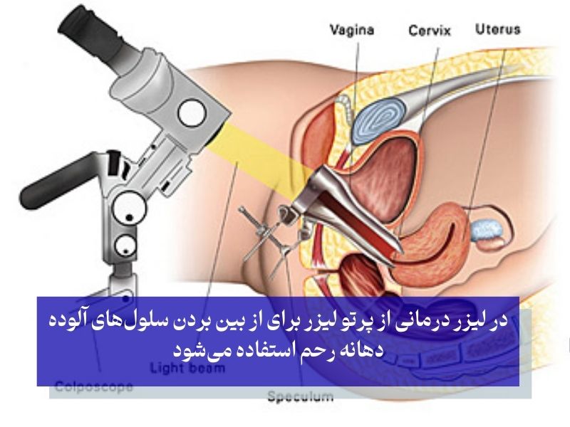پرتو لیزر برای از بین بردن سلولهای آلوده دهانه رحم