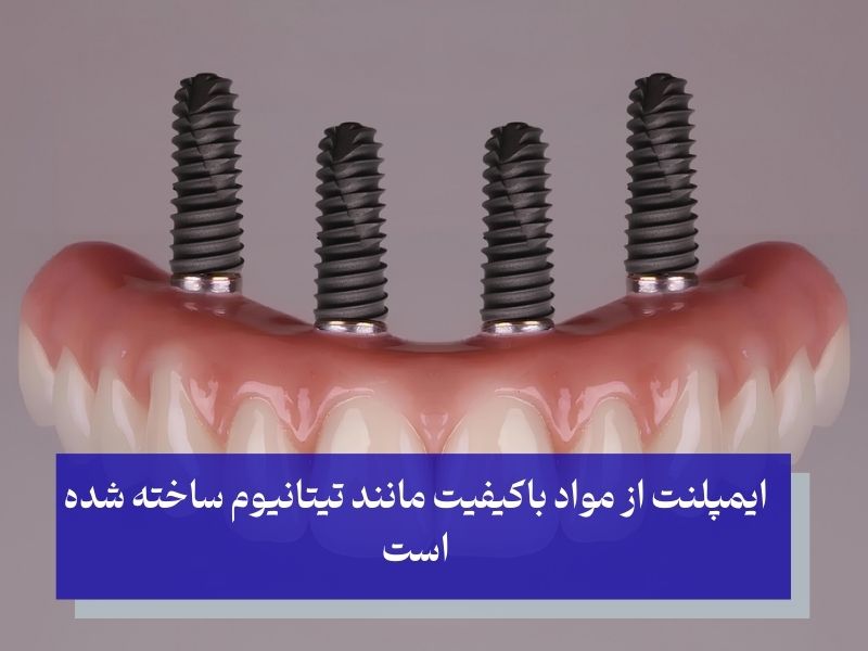 ماندگاری طولانی مدت از مزایای ایمپلنت دندان