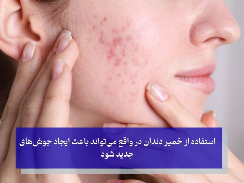 استفاده از خمیر دندان و ایجاد جوش جدید صورت