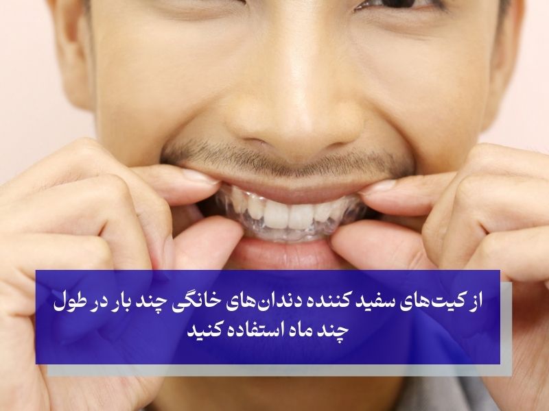 معایب بلیچینگ دندان در خانه