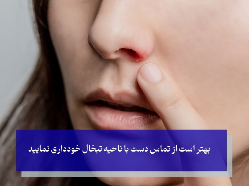 رفع تبخال بینی در سه دقیقه