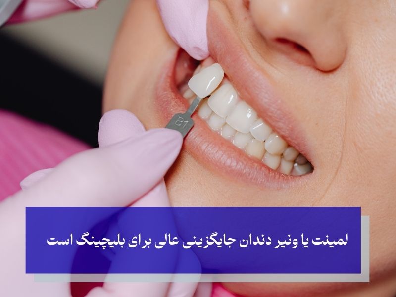 بلیچینگ دندان و گزینه‌های جایگزین