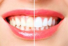 بلیچینگ دندان چقدر دوام دارد