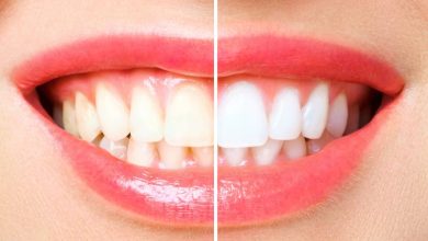 بلیچینگ دندان چقدر دوام دارد