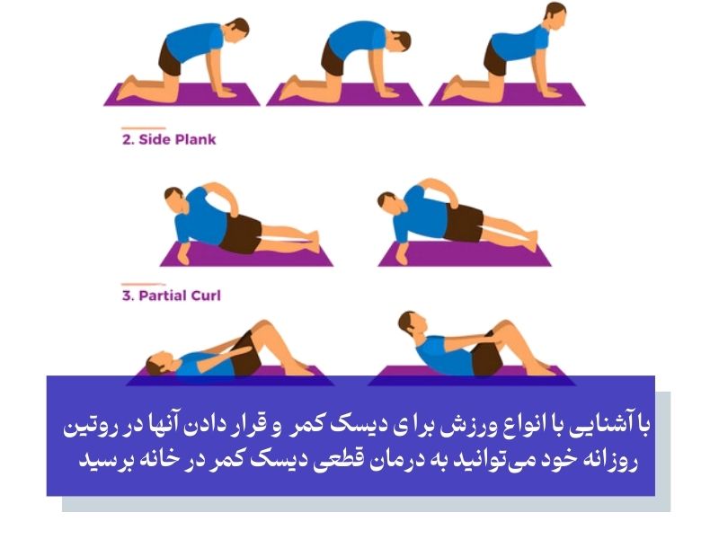 درمان قطعی دیسک خفیف کمر