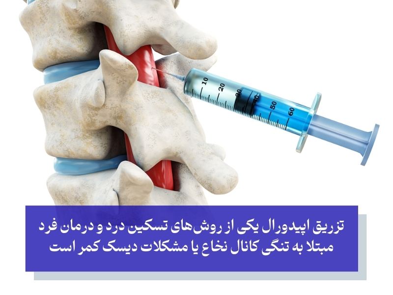 شرایط استفاده از اپیدورال