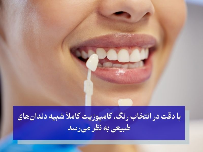 مزایای کامپوزیت دندان