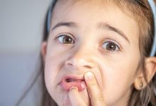 آفت دهان کودک