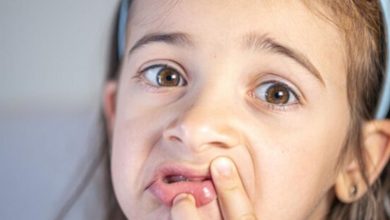آفت دهان کودک